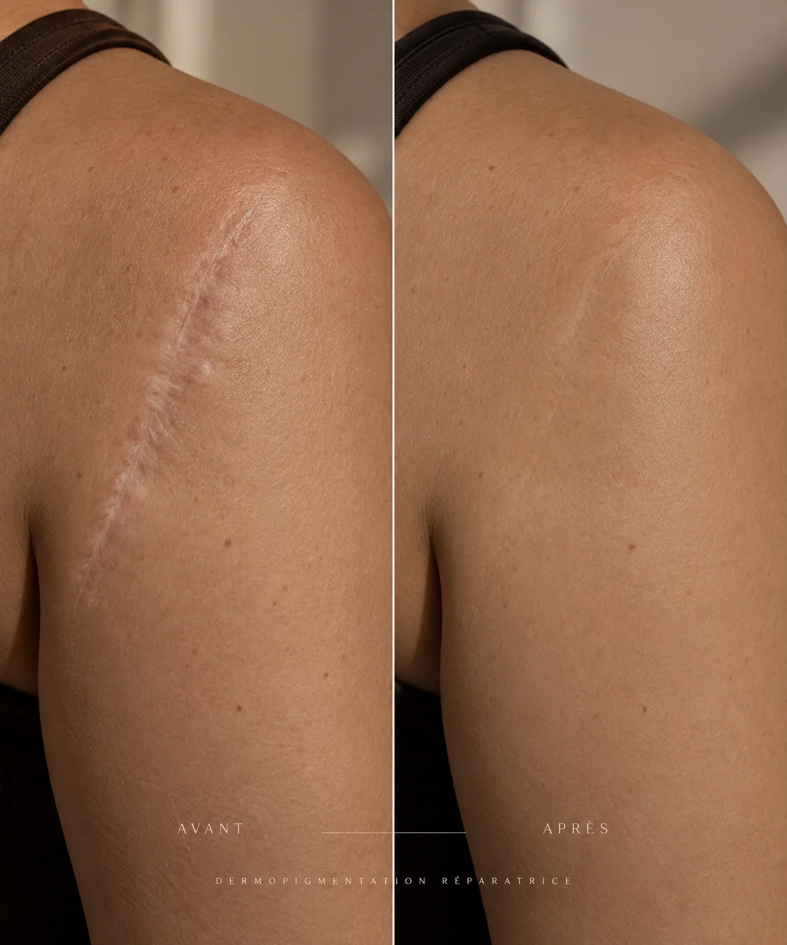Avant et après une dermopigmentation réparatrice de cicatrice